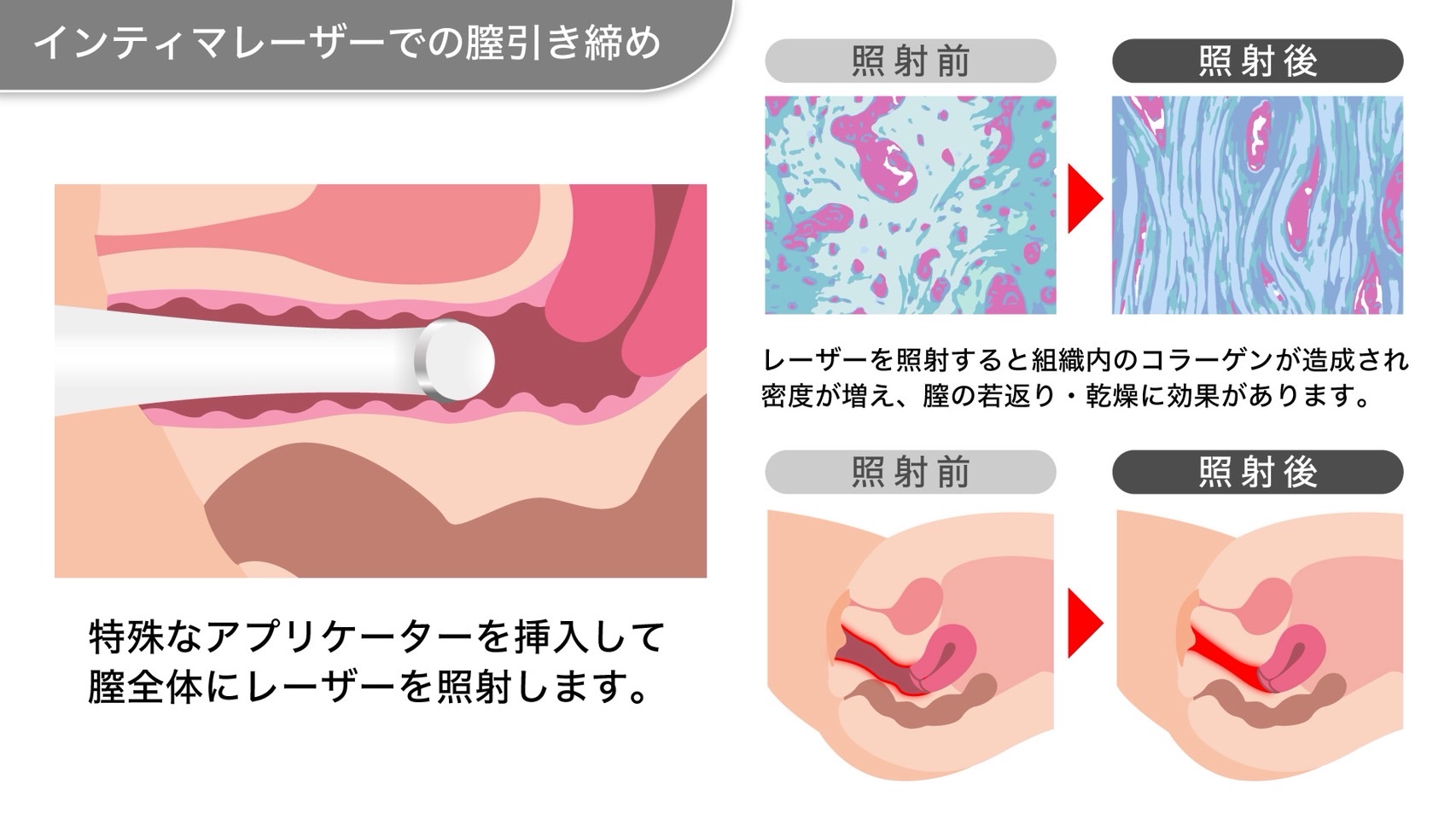 Yoni RF 施術イメージ